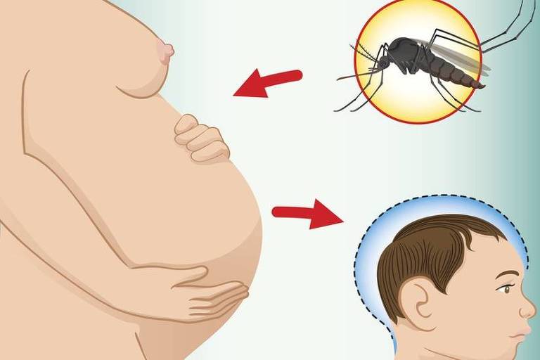 Ilustração demonstrando relação entre a contaminação por zika na gravidez e a microcefalia