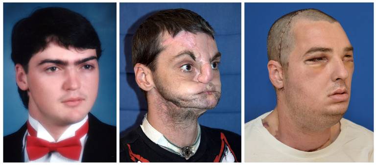 Diferentes imagens de homem com rosto transplantado