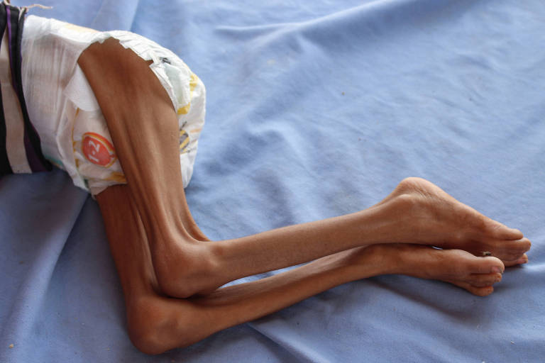 Iêmen sofre com a fome