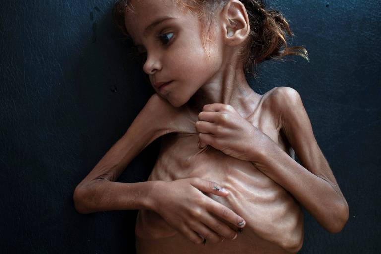 Morre menina que chamou atenção para as consequências da guerra no Iêmen