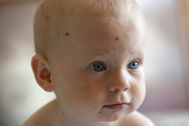 Bebê com pintas vermelhas no rosto