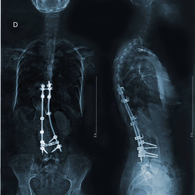 Radiografia mostra pessoa de frente e de lado com coluna com hastes, parafusos e ganchos