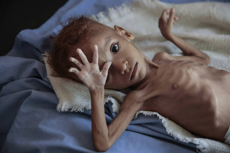 Crise de fome se agrava no Iêmen, e 20 milhões sofrem desnutrição, aponta ONU