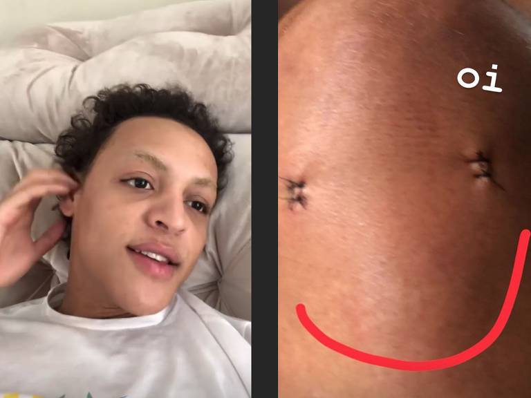 Pabllo Vittar fala sobre cirurgia no joelho pelo Instagram