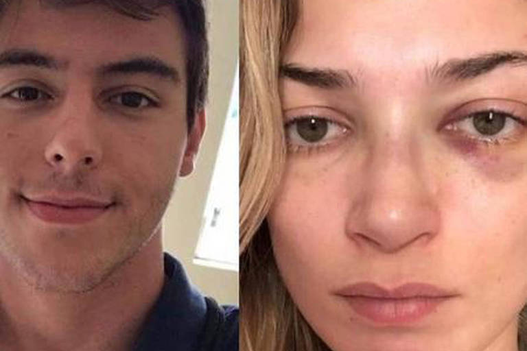 Luciana Sinzimbra publica em suas redes sociais uma foto do rosto machucado e do ex-namorado, Victor Junqueira