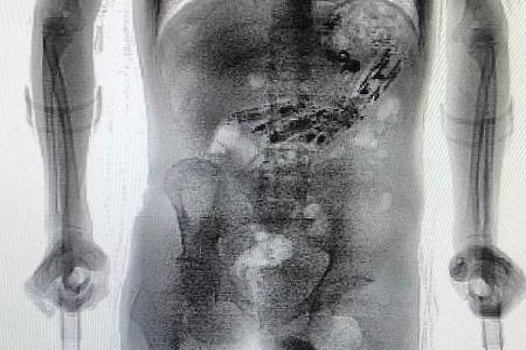 Raio-X mostra celulares e outros objetos encontrados em estômago de preso em SC