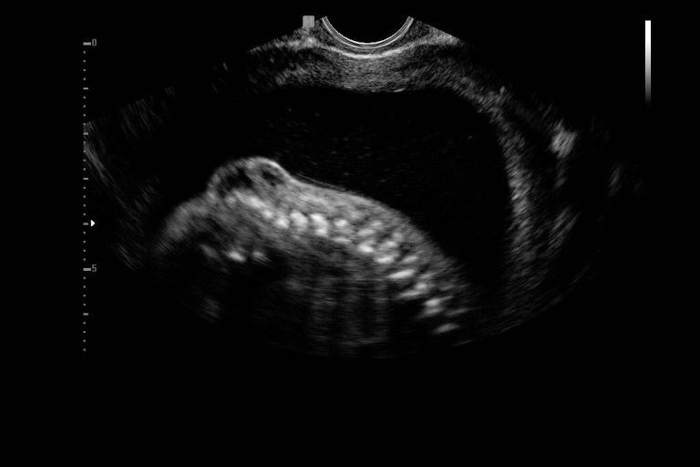 Imagem de ultrassom mostra, à esquerda, a malformação; o procedimento pelo qual passaram Karem e Enzo pode ser uma alternativa à cirurgia a céu aberto