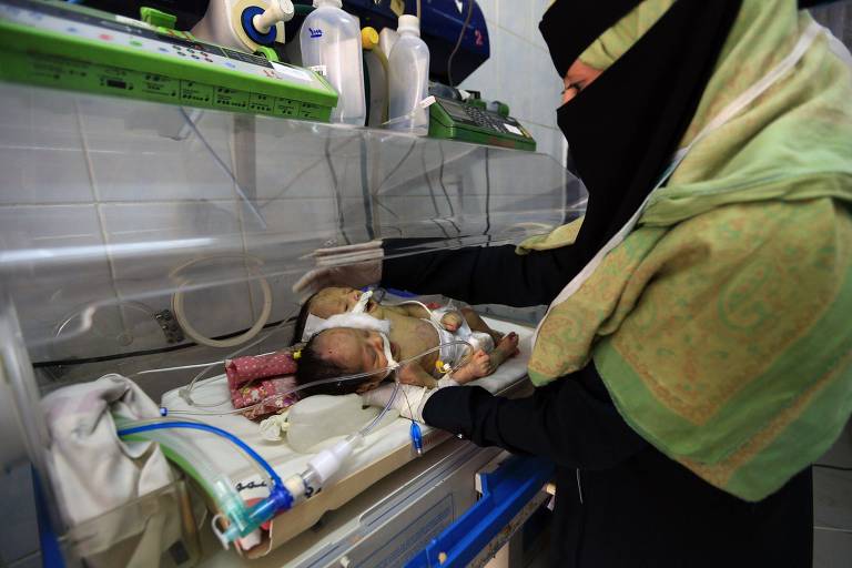 Bebês iemenitas siameses; médicos sugerem separação