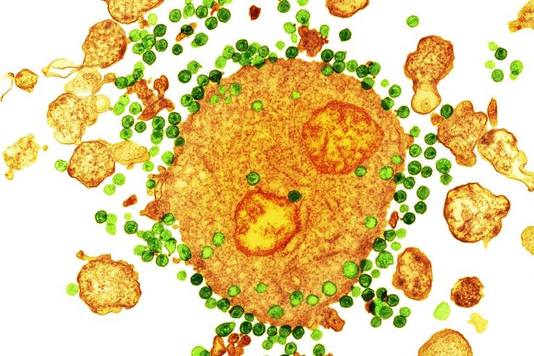 Uma micrografia electrica de transmissão colorida da H.I.V. vírus, em verde, anexando a um glóbulo branco, em laranja.CreditCreditNIBSC / Science Source