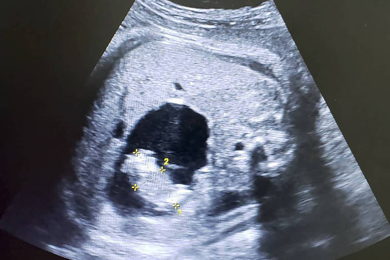 Ultrassom mostra pequeno feto se formando dentro do abdome de sua irmã gêmea no útero; médicos pensaram que era um cisto