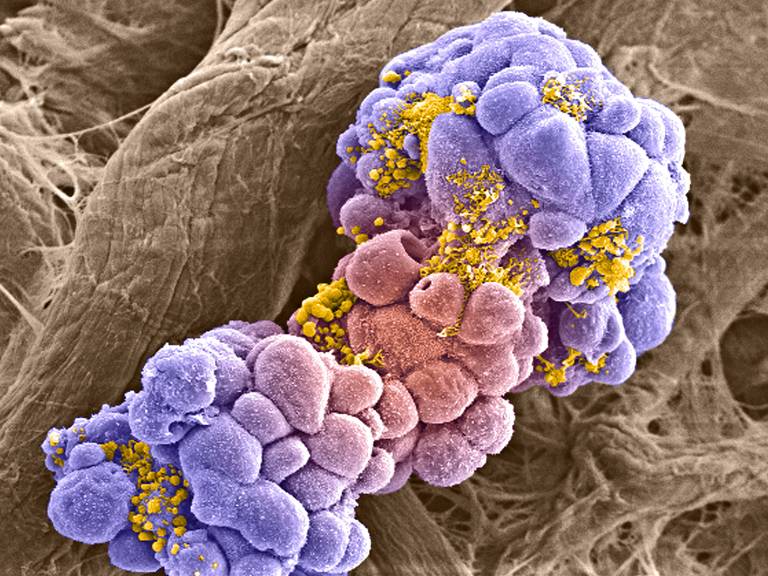Células de câncer de mama, vistas com auxílio de microscópio eletrônico