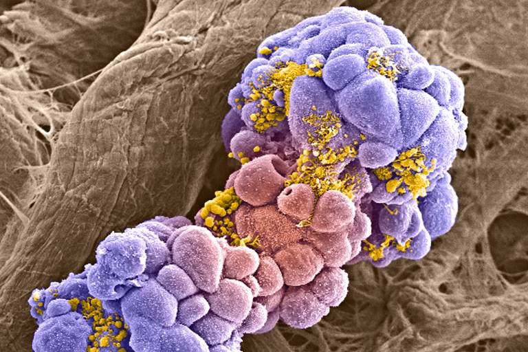 Células de câncer de mama, vistas com auxílio de microscópio eletrônico