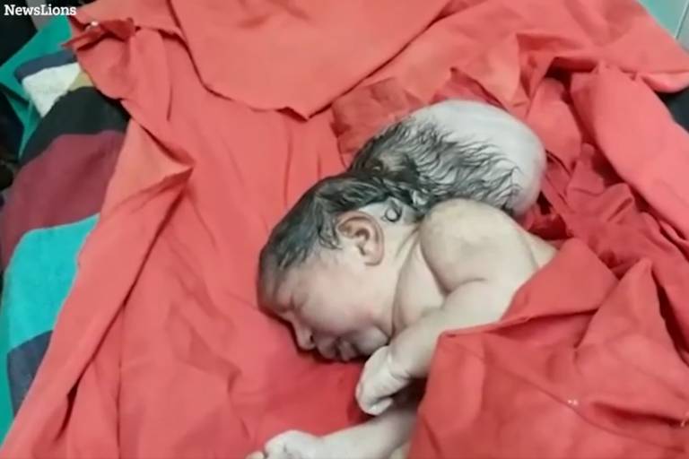 Pai enterra vivo bebê que nasceu com protuberância na cabeça na Índia