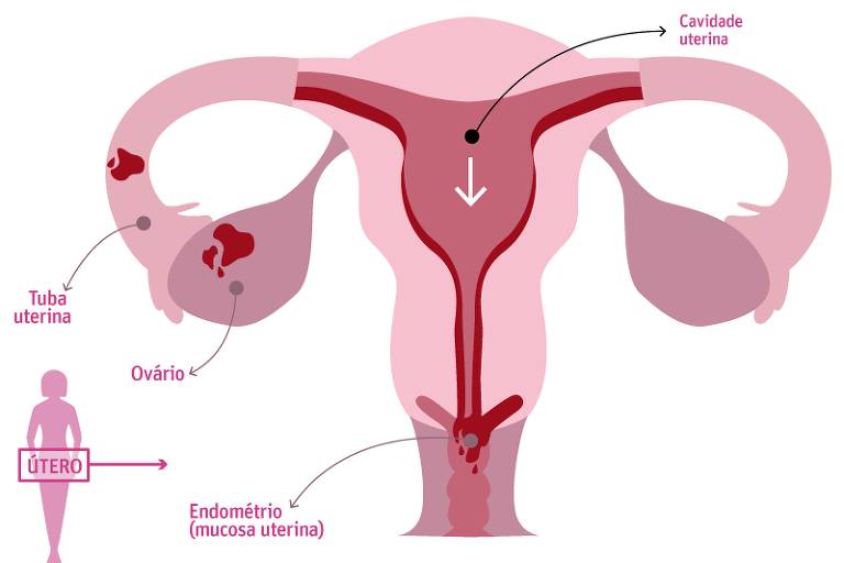 Ilustração mostra endometriose no útero