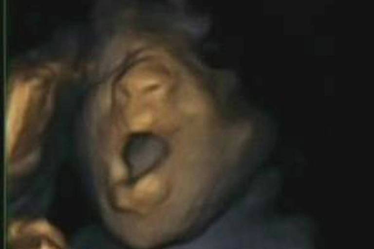 Ultrassom mostra um bebê dentro da barriga da mãe, bocejando
