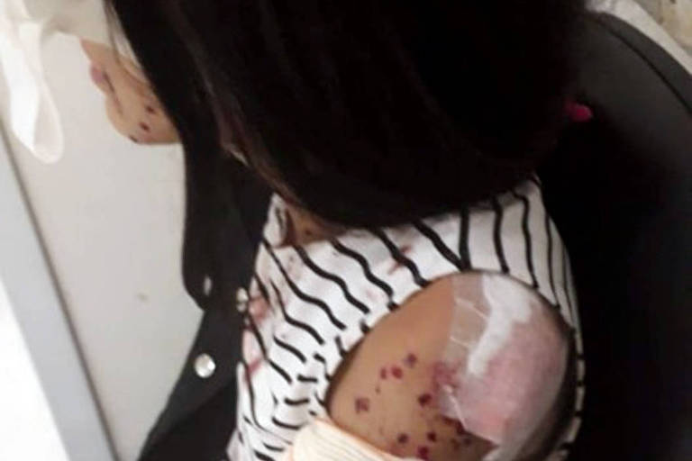 Taissa Neris, 15, que foi atingida por tiro de bala de borracha em novembro de 2018 