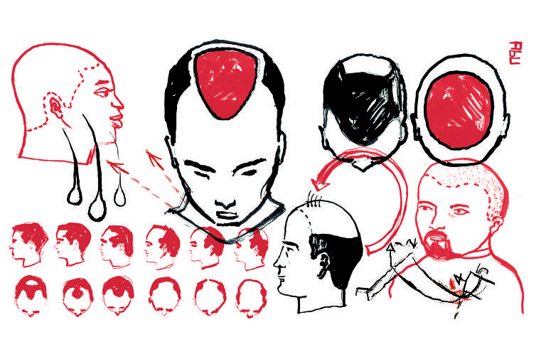 ilustração em vermelho e preto mostra processo de transplante de cabelo em várias etapas. 