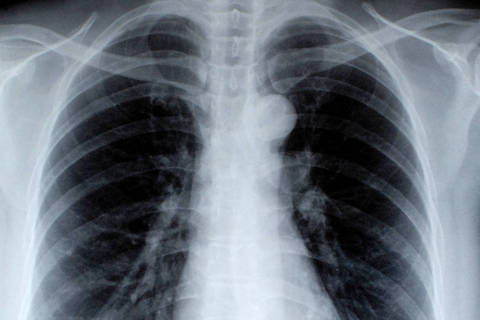 Diminuição de mortes por câncer de pulmão puxou queda de taxa de mortalidade por câncer nos EUA