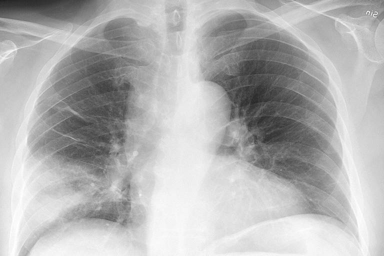 Radiografia do pulmão mostra pneumonia em paciente de 67 anos 