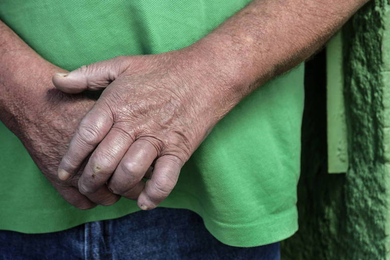 Mãos de pessoa que teve hanseníase e ficou com sequelas no membro; no caso, mãos ficam com aparência de garras, com dedos mais fechados
