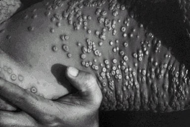 Lesões na pele causadas por varíola, doença infecciosa erradicada em 1977; a foto foi feita em Bangladesh, em 1973; é uma foto em preto e branco, na qual se vê um detalhe de uma mão e uma grande porção de pele que o corte da imagem não permite identificar, talvez um torso, cheio de bolinhas altas, uma do lado da outra, e cada lesão tem uma espécie de furinho no centro