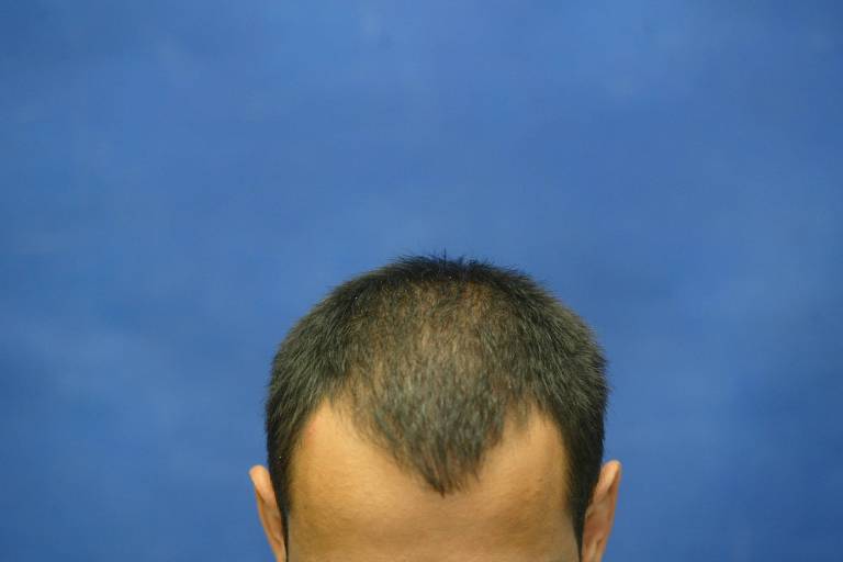 Cabeça de homem com alopecia androgenética, a popular calvície