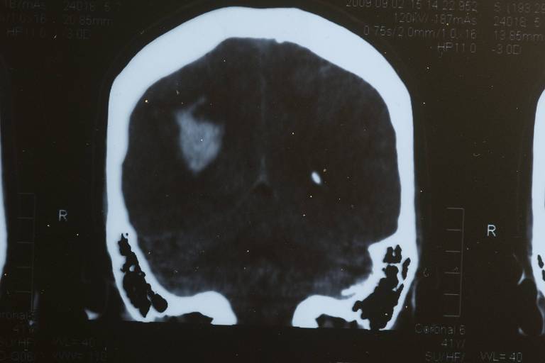 Imagem de uma tomografia cerebral