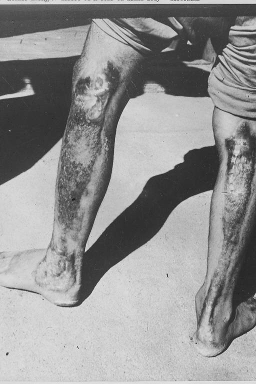 Homem exibe queimaduras provocadas pela explosão nuclear da bomba 'Little Boy' em Hiroshima, Japão