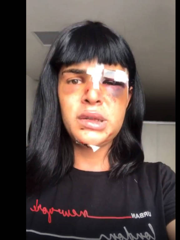 Rosto de transexual de cabelo preto comprido com machucados no rosto depois de ser agredida