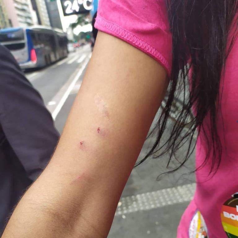 Braço de Patricia Borges, apoiadora de Erika Hilton, após agressões na Avenida Paulista