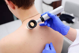 the doctor dermatologist examines birthmarks and birthmarks of the patient with a dermatoscope