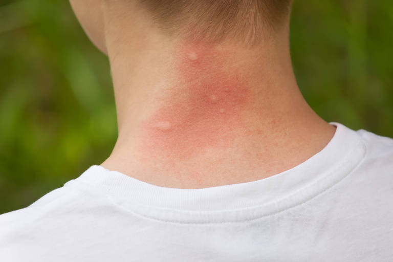 mosquito bites on the neck.
