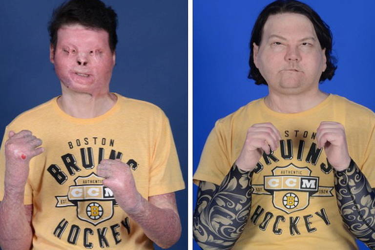 Antes e depois do transplante de mãos e face de Joe DiMeo, 22
