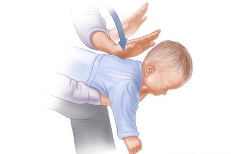 Técnica para desengasgar bebê de influenciadora não é manobra de Heimlich, dizem especialistas
