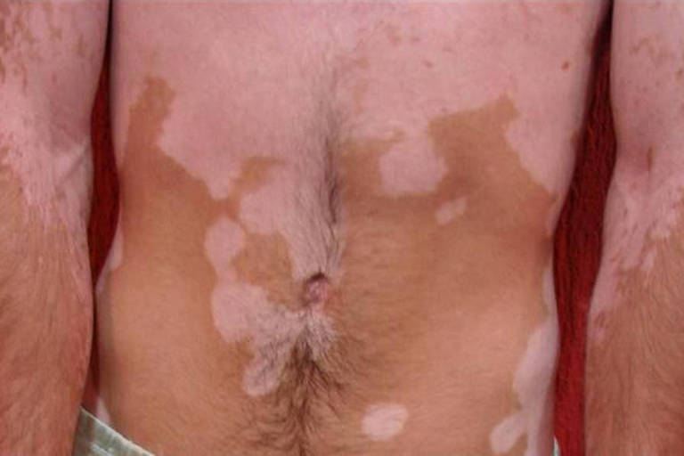 detalhe de abdômen e braços de homem com vitiligo