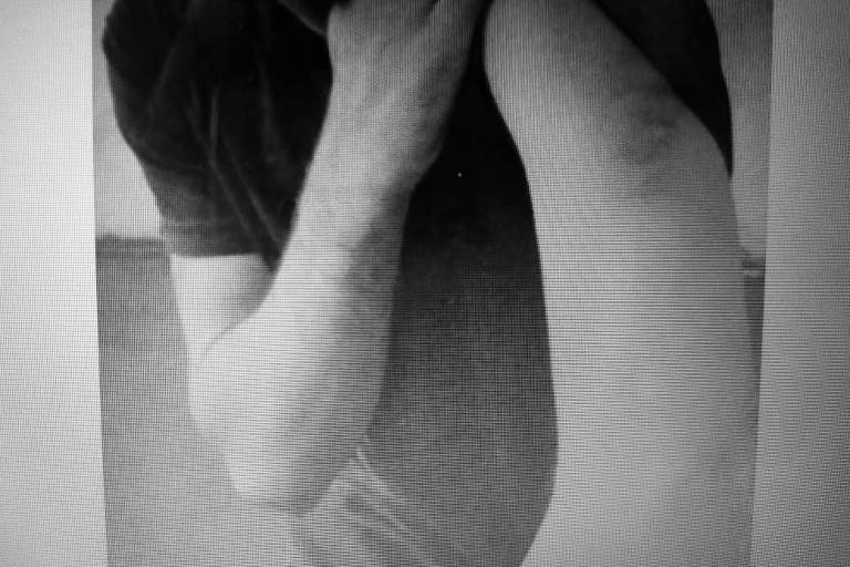 Hematoma em braço de jovem agredido da Fundação Casa, em SP