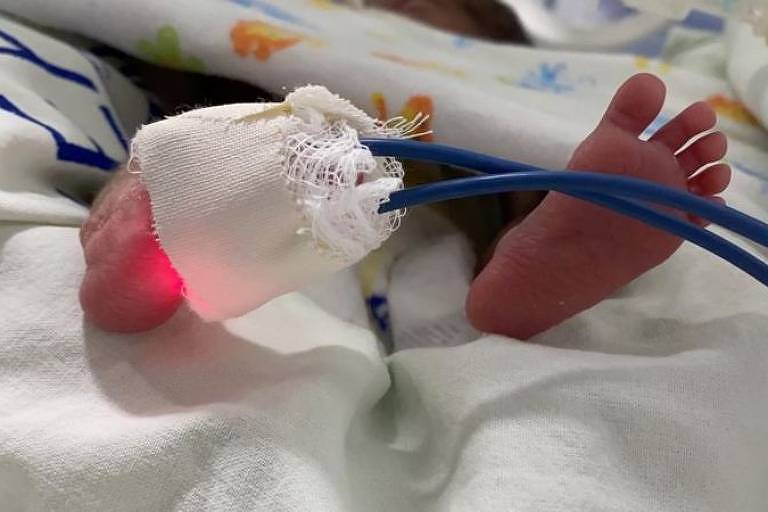 Filhas de Expedito nasceram com 26 semanas, mas se recuperam bem na UTI neonatal