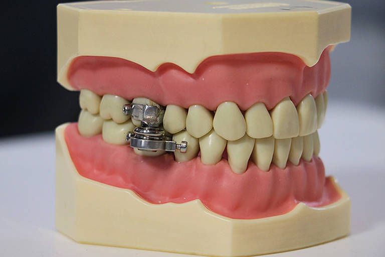 Dispositivo criado pela Universidade de Otago, da Nova Zelândia, que usa ímãs para limitar a abertura da boca e perder peso