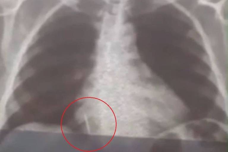 Imagem da radiografia da broca no pulmão de paciente