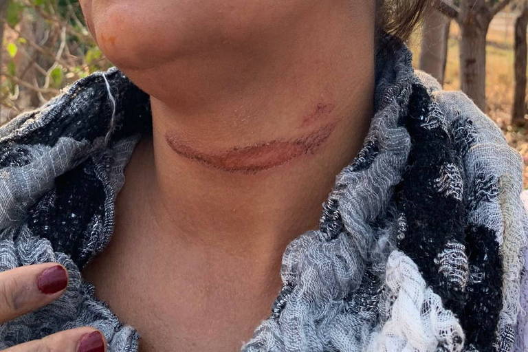 Mulher mostra as marcas deixadas em seu pescoço após ser amarrada 
