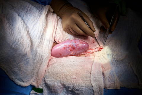 A genetically engineered pig kidney appears healthy during a transplant operation at NYU Langone in New York, U.S., in this undated handout photo. Joe Carrotta for NYU Langone Health/Handout via REUTERS  NO RESALES. NO ARCHIVES. THIS IMAGE HAS BEEN SUPPLIED BY A THIRD PARTY. ORG XMIT: HFS-NYK994