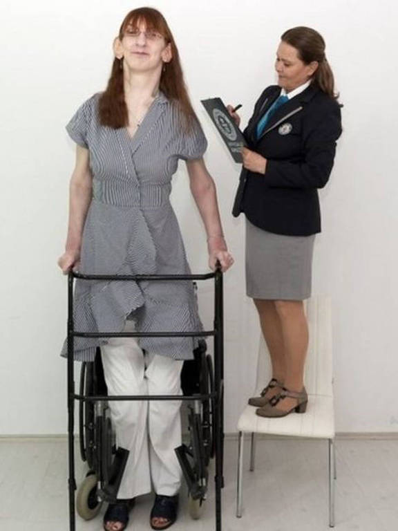 Rumeysa Gelgi, a mulher mais alta do mundo: o que é a síndrome de Weaver, que a deixou tão alta