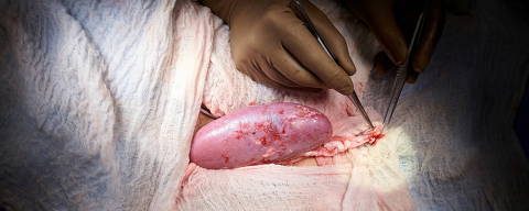 A genetically engineered pig kidney appears healthy during a transplant operation at NYU Langone in New York, U.S., in this undated handout photo. Joe Carrotta for NYU Langone Health/Handout via REUTERS  NO RESALES. NO ARCHIVES. THIS IMAGE HAS BEEN SUPPLIED BY A THIRD PARTY. ORG XMIT: HFS-NYK994