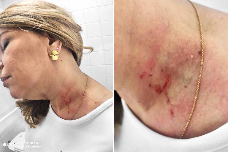 Marca da agressão no pescoço da vereadora Cris Monteiro