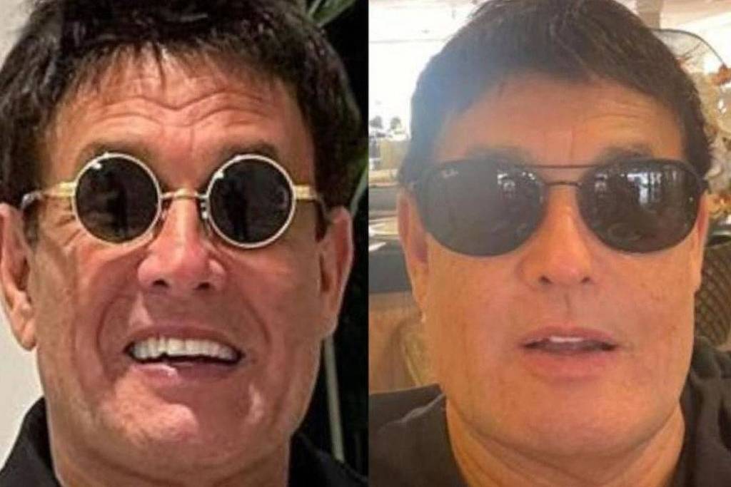 Bruno Diferente faz harmonização facial e compartilha resultado na web, Celebridades