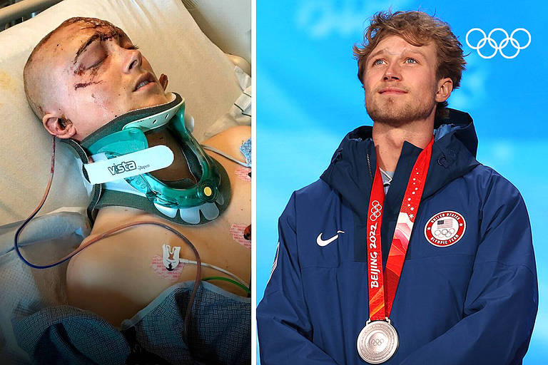 Seis anos após sofrer 30 fraturas no crânio, americano ganha a prata nas Olimpíadas