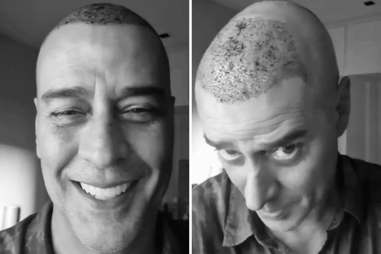 Marcello Antony mostra resultado de transplante de cabelo