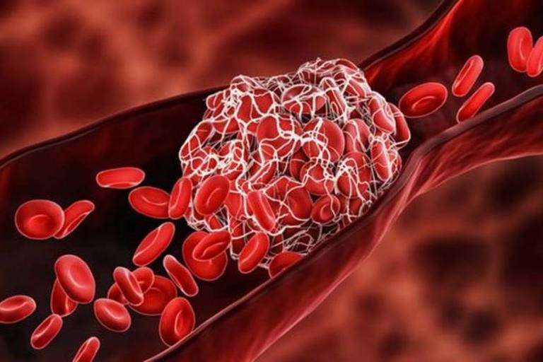 Ilustração mostra massa de células bloqueando a passagem do sangue numa veia