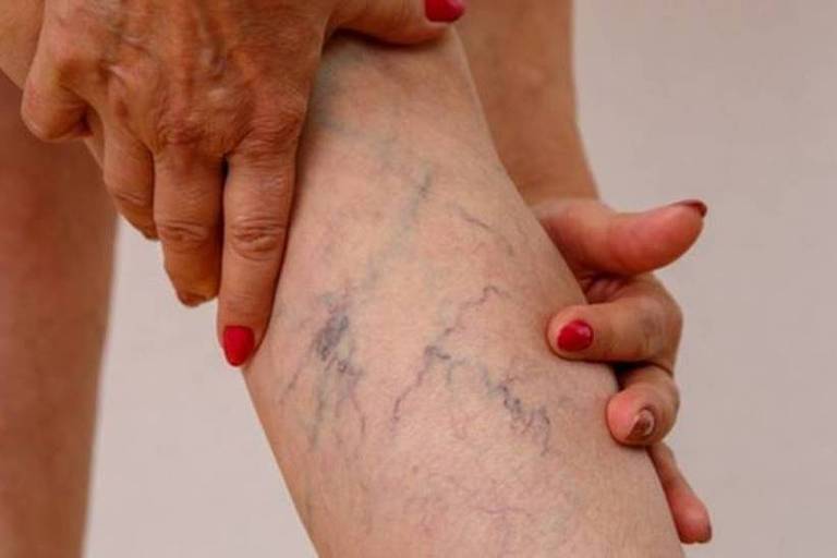 Imagem em close mostra as mãos de uma mulher segurando uma das pernas e mostrando varizes