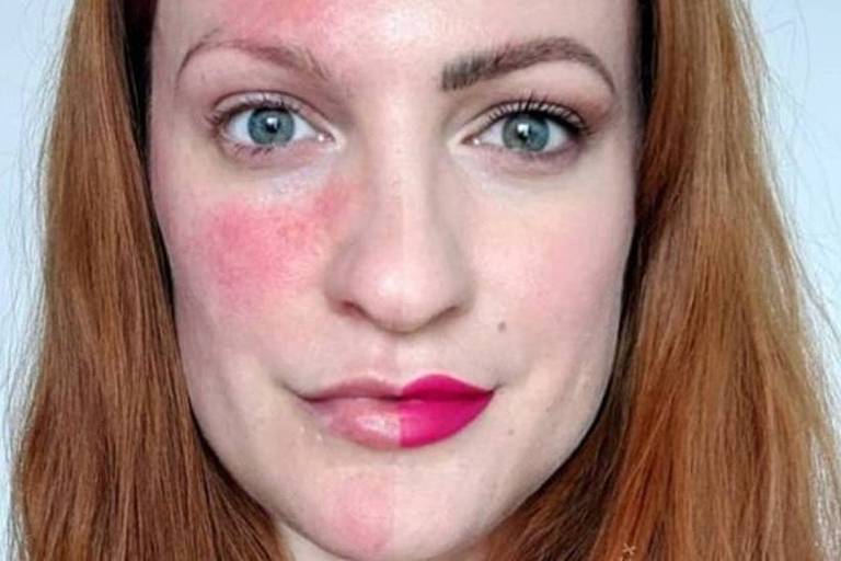 Lex Gillies, hoje com 37 anos, foi diagnosticada com rosácea aos 21